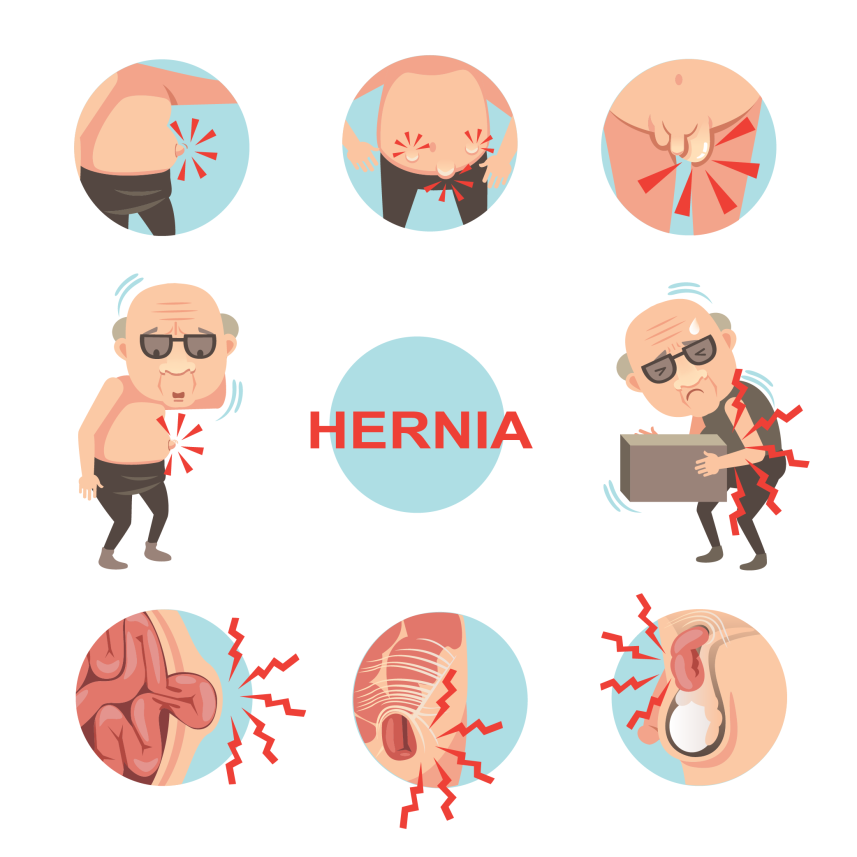 Hernia - Causes, Symptoms, Types and Treatment