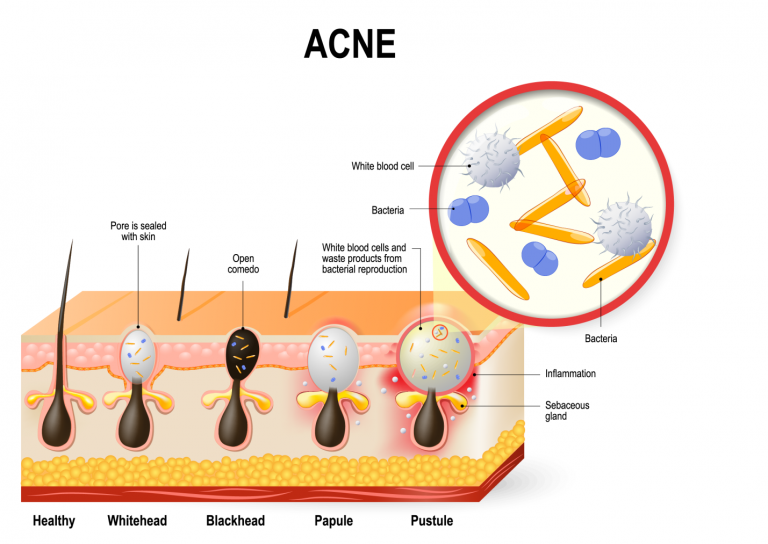Acne – Risk factors, Diagnosis and Treatment