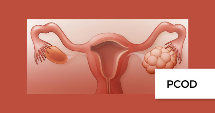PCOD (Polycystic Ovarian Disease) & PCOS