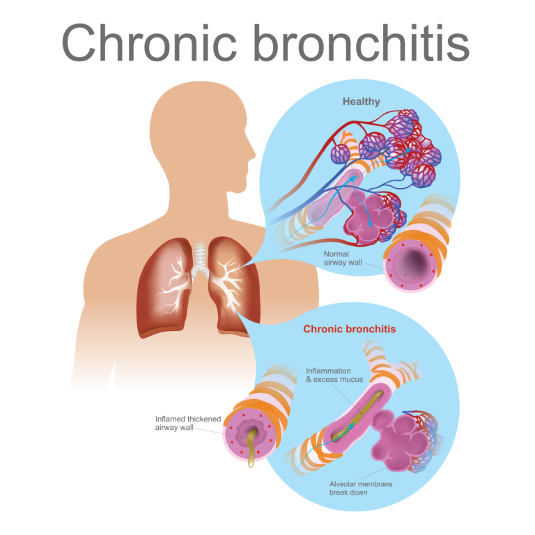Bronchitis  Symptoms, Causes and Treatment  Apollo Hospital Blog