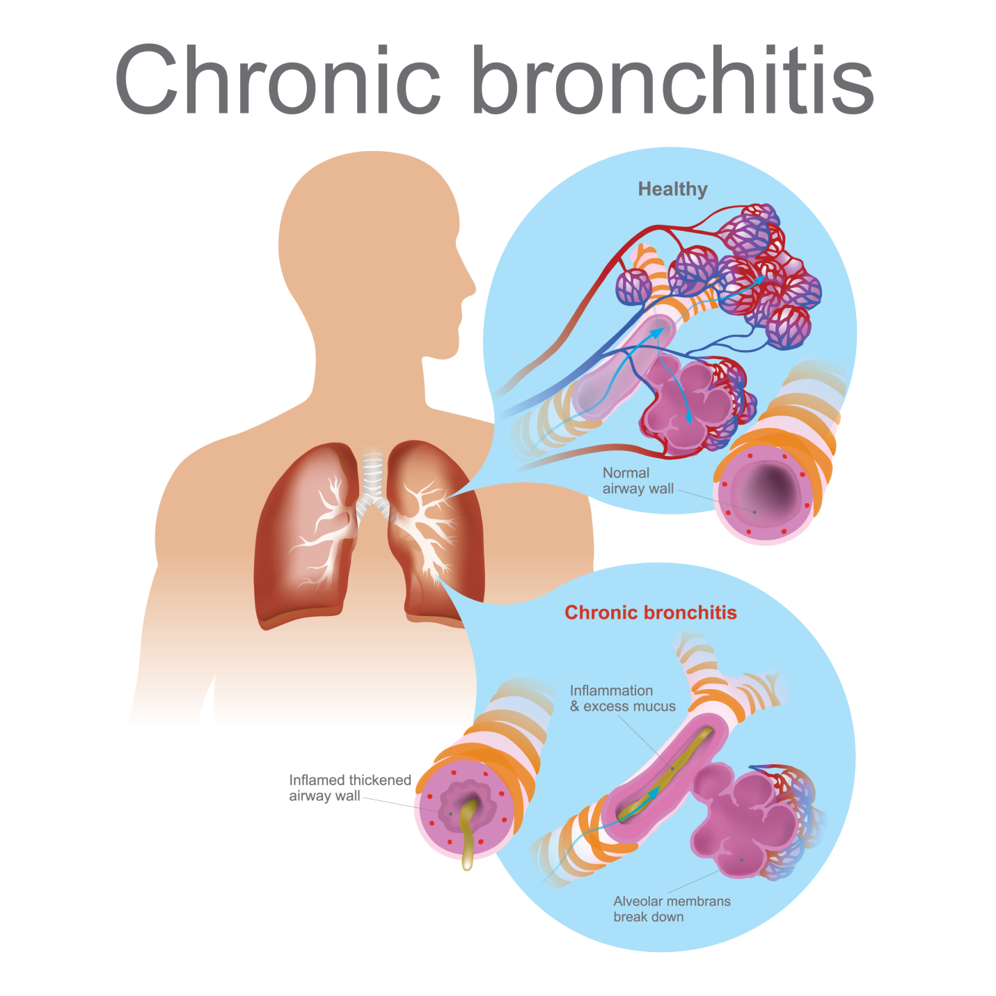 bronchitis presentation
