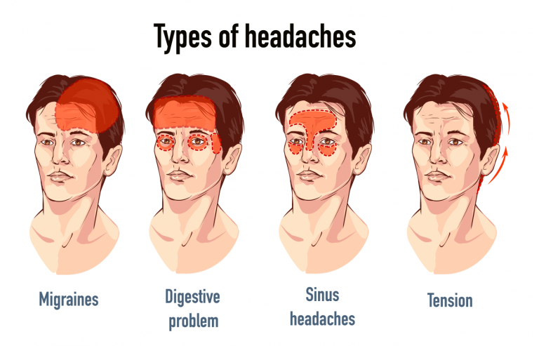 Headache - Causes, Symptoms, Diagnosis, Types and Treatment