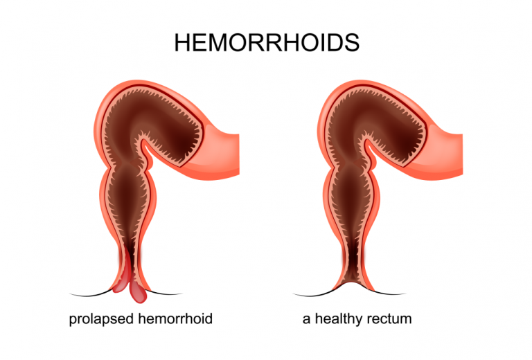 Hemorrhoids or Piles – Symptoms, Causes and Treatment