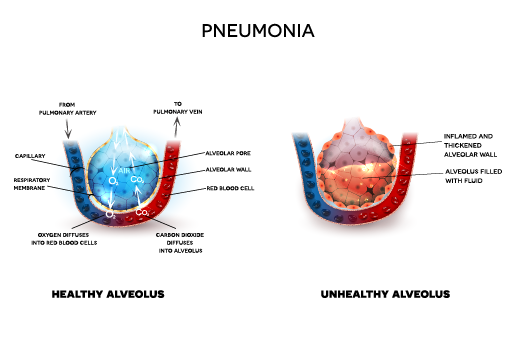 Pneumonia – Causes, Symptoms and Treatment