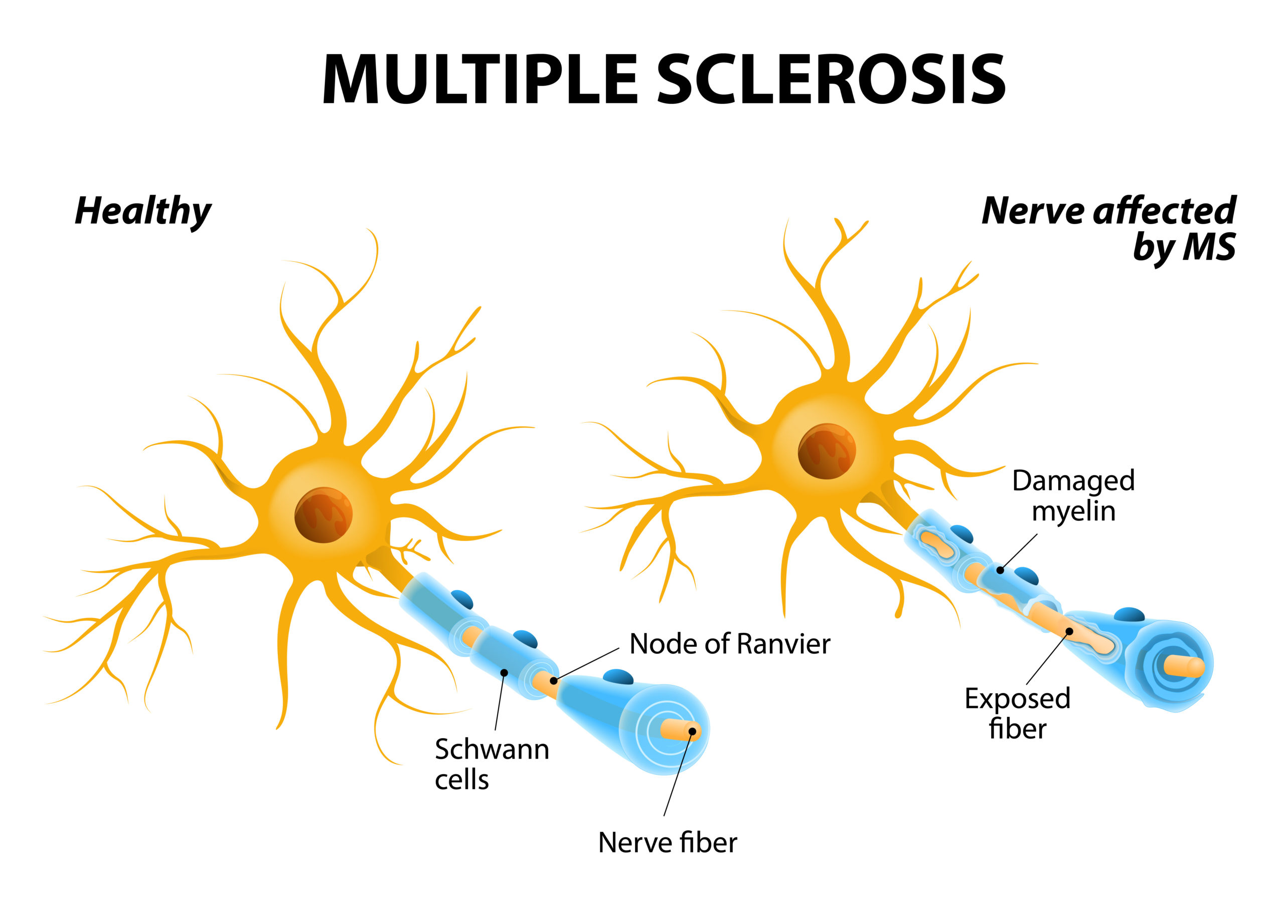 Multiple Sclerosis Symptoms Causes And Treatment