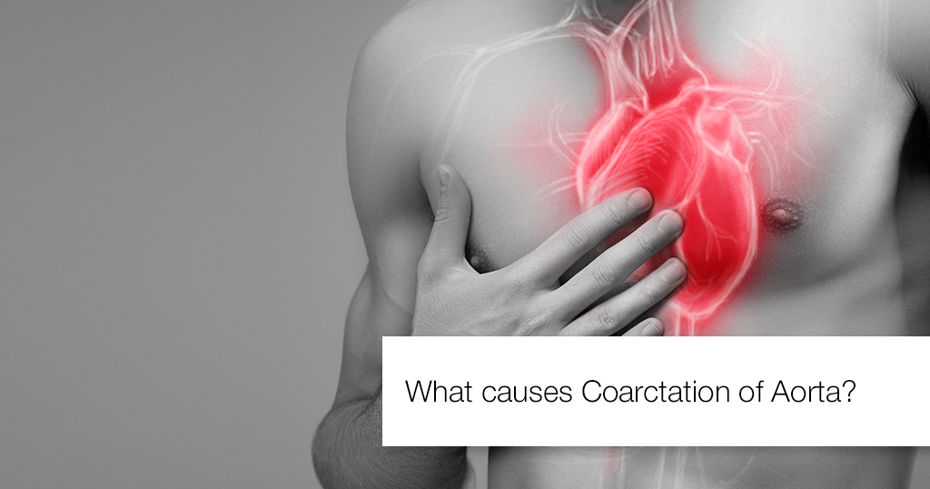 WHAT CAUSES COARCTATION OF AORTA
