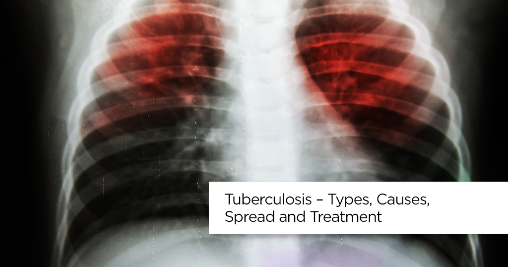 Tuberculosis Symptoms, Causes and Treatment
