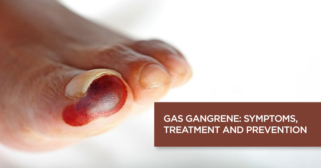 Gas Gangrene: Causes, Symptoms, Prevention and Treatment