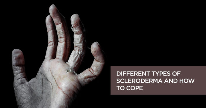 Different Types of Scleroderma