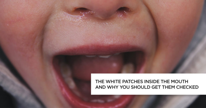 White Patches - leukoplakia