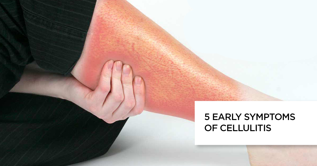 5 Early Symptoms of Cellulitis : Causes, Treatment and Faq's