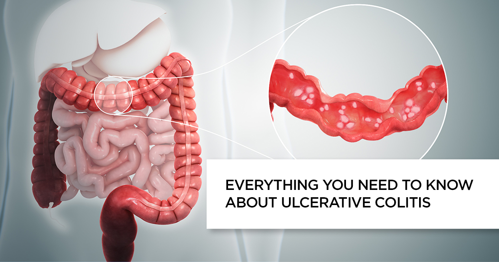 Ulcerative Colitis: Symptoms, Causes, Lifestyle Changes & Treatment