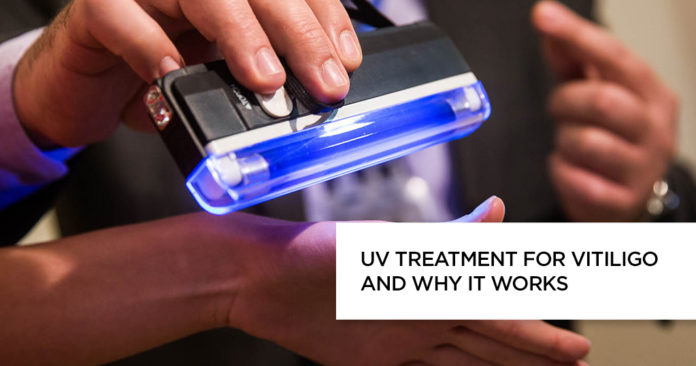 UV Treatment for Vitiligo