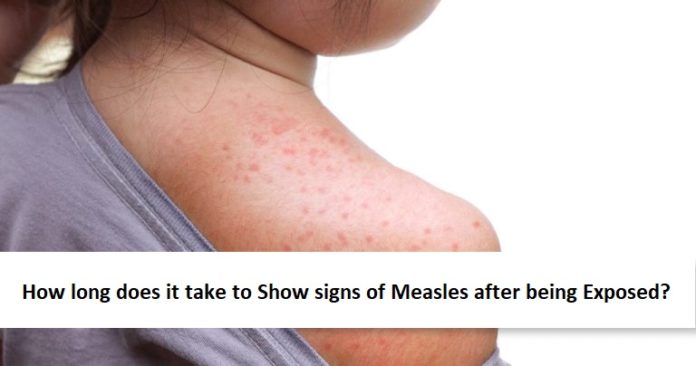 signs of Measles