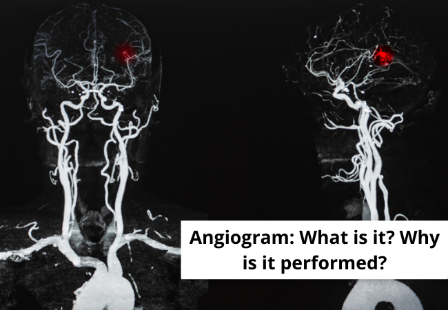 Angiogram What is it Why is it performed