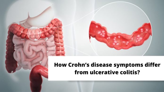 How Crohn’s disease symptoms differ from ulcerative colitis