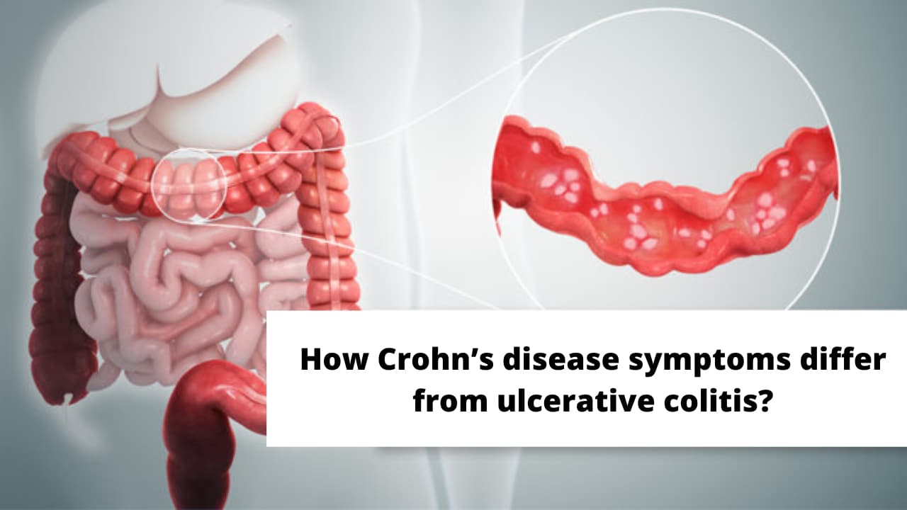 What is Crohn's disease? Causes and Symptoms and Risk Factors