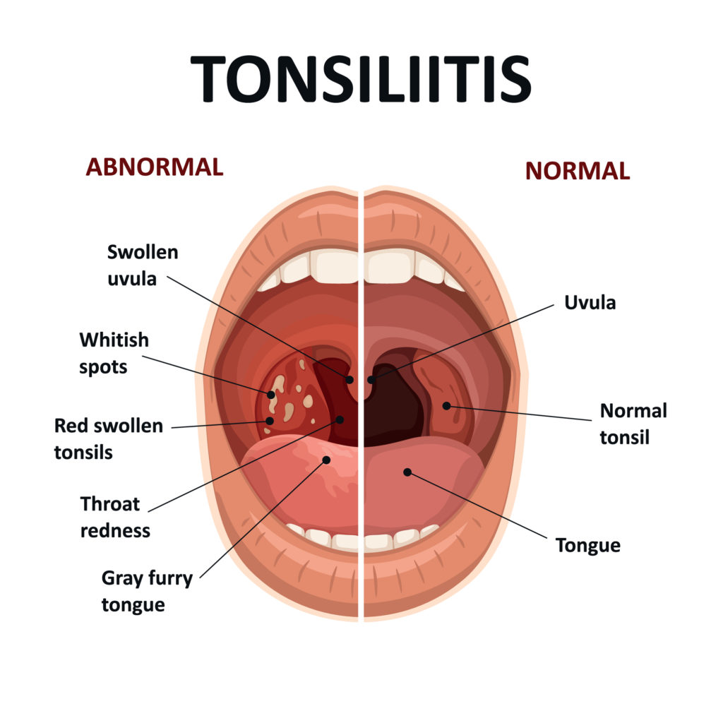 Tonsillitis : Symptoms, Causes, Risk factors and Treatments