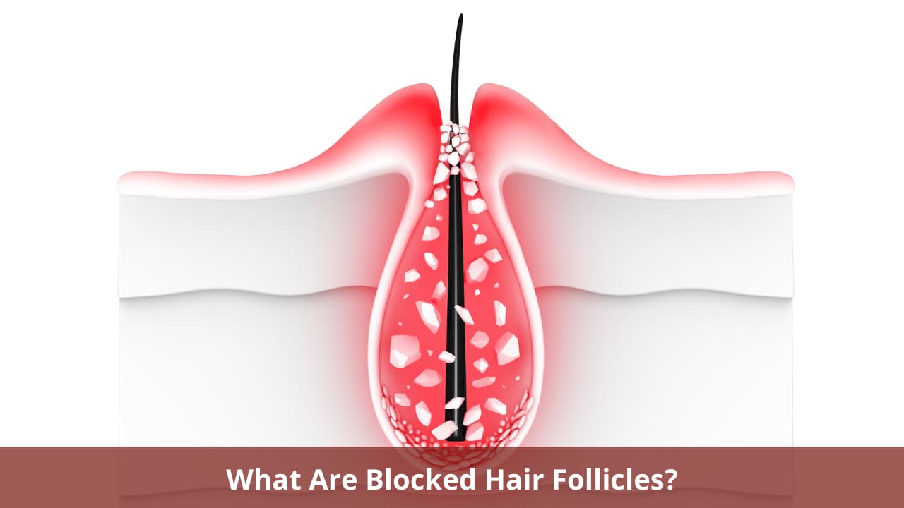Blocked Hair Follicles : Symptoms, Causes, and Treatment