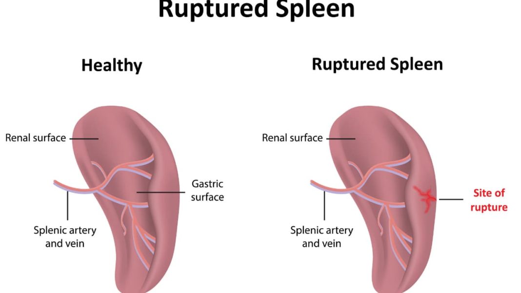 Ruptured Spleen Symptoms Causes Treatment And Recovery