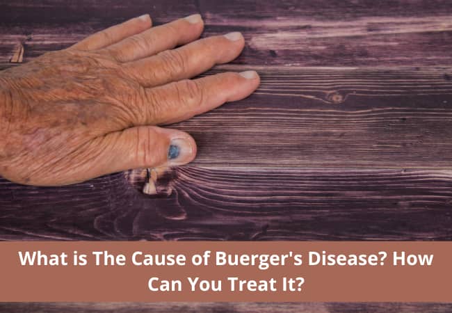 What is The Cause of Buerger's Disease How Can You Treat It