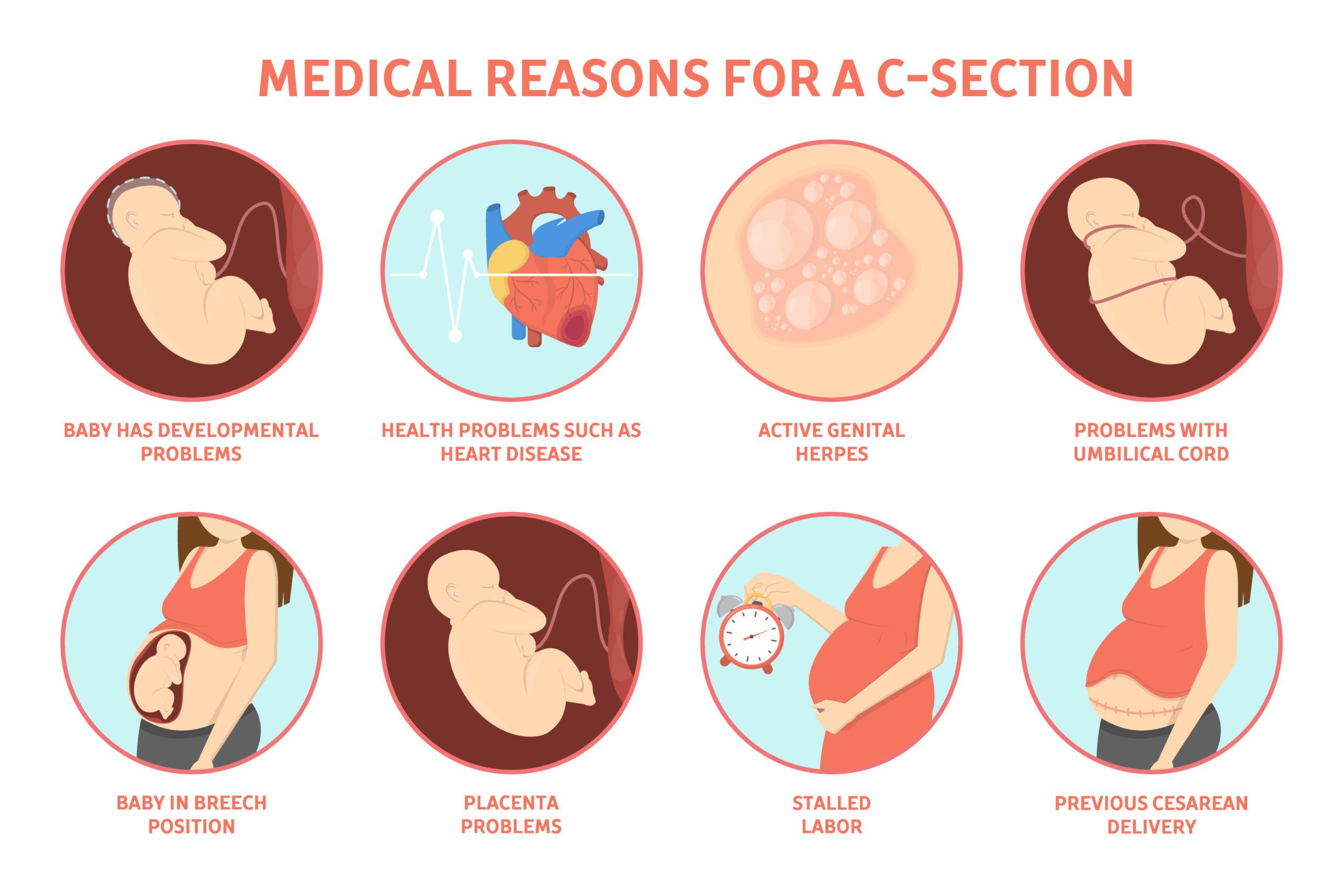 Pros & Cons – Cesarean section or Normal Delivery – What