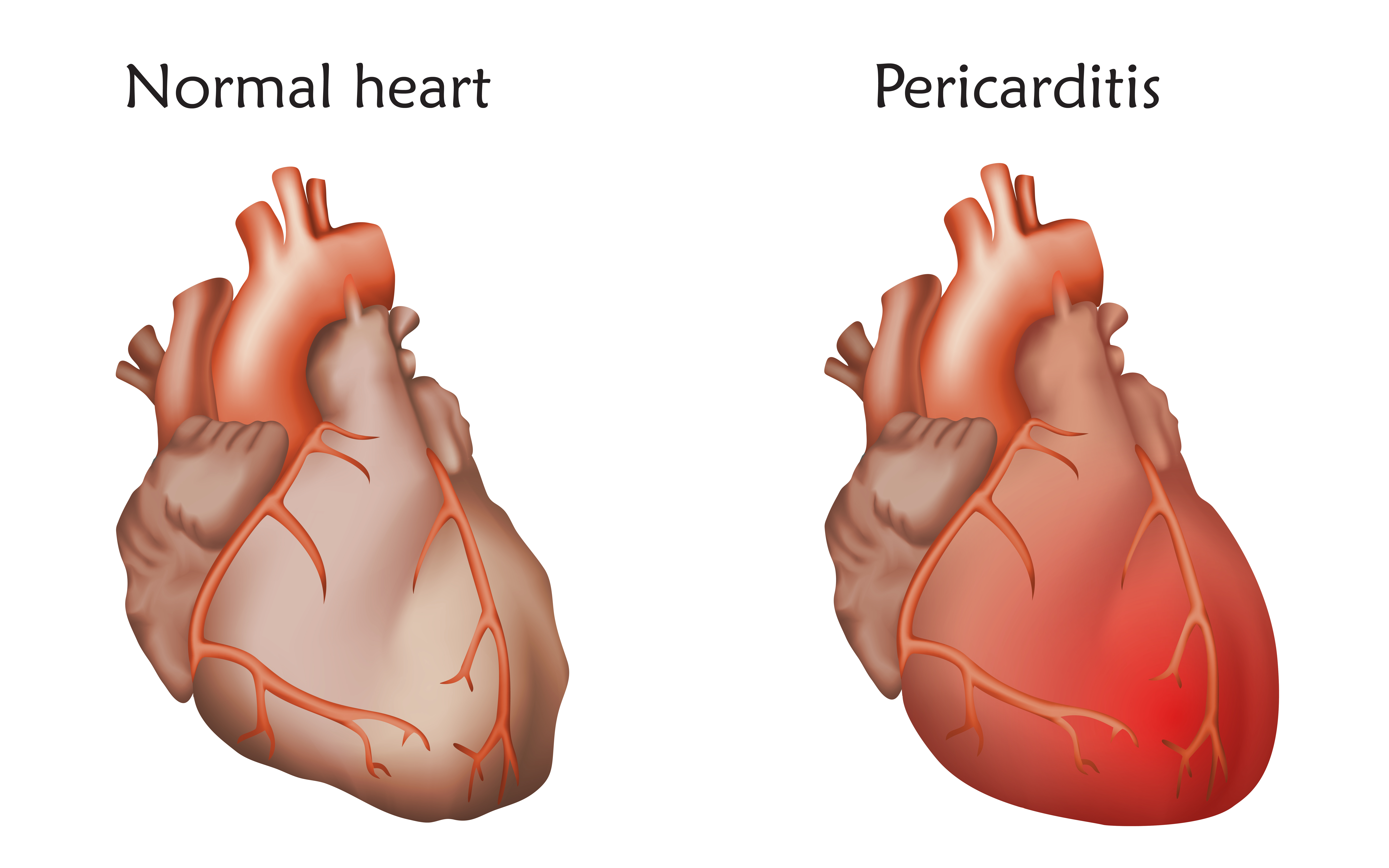 Pericarditis Treatment: How to Get Rid of Pericarditis Fast 1