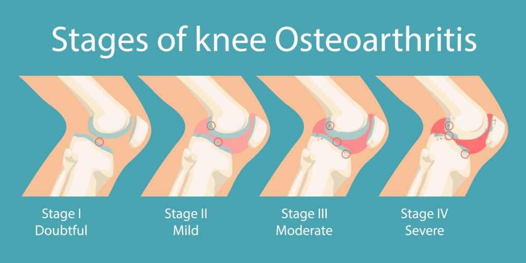 Osteoarthritis symptoms knee