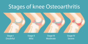 Osteoarthritis - Stages, Symptoms, Causes, Diagnosis, and Treatment