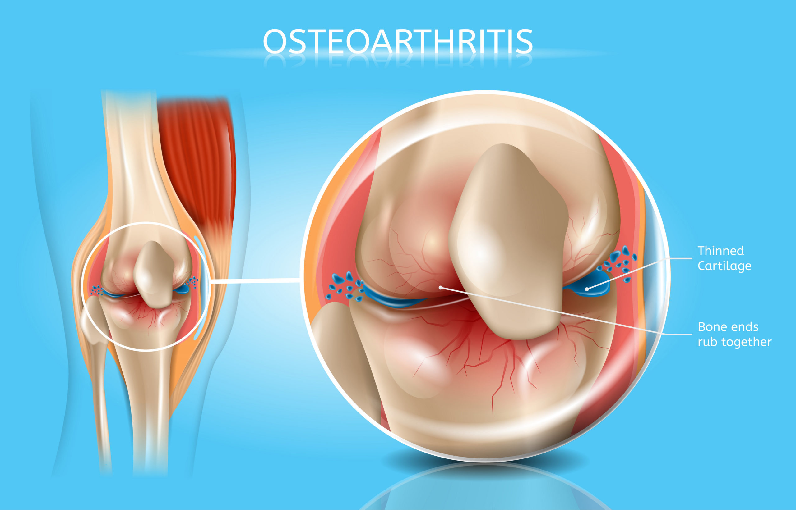 Osteoarthritis Symptoms & Treatment