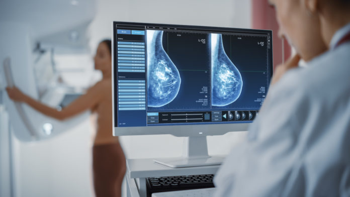 3D Mammogram or Tomosynthesis