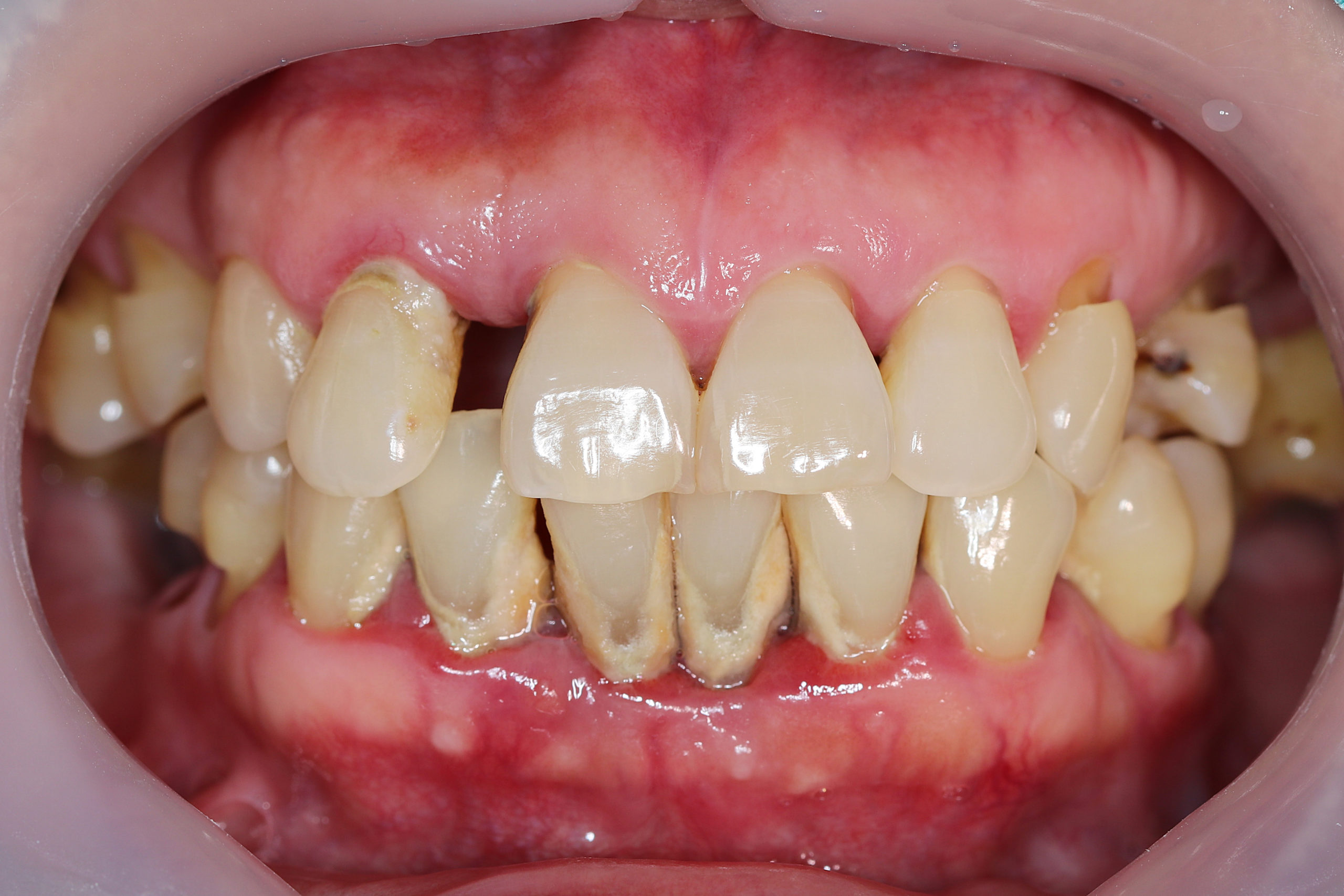 Cao răng bám xung quanh cổ răng và chân răng