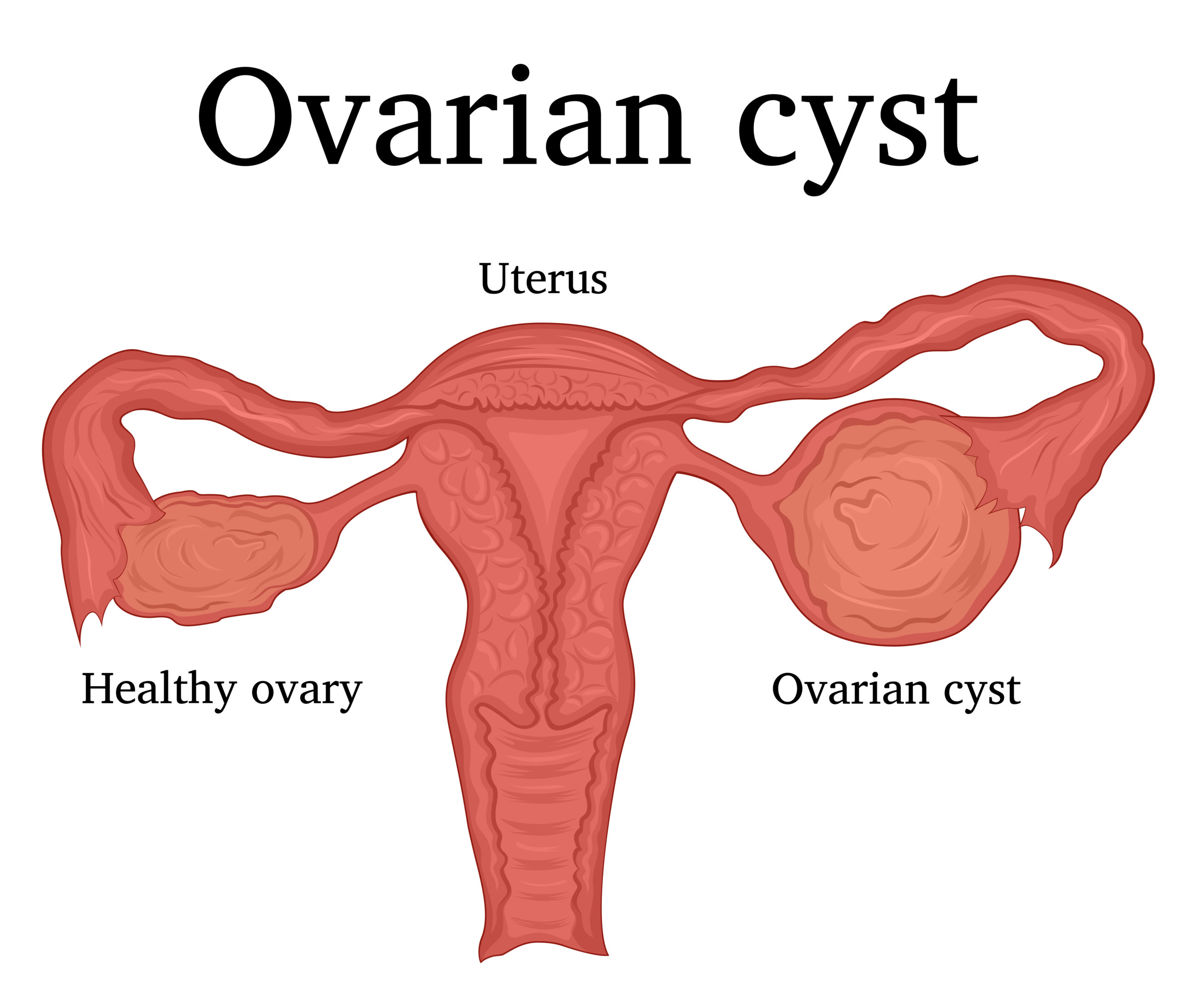 Cyst ovary dermoid