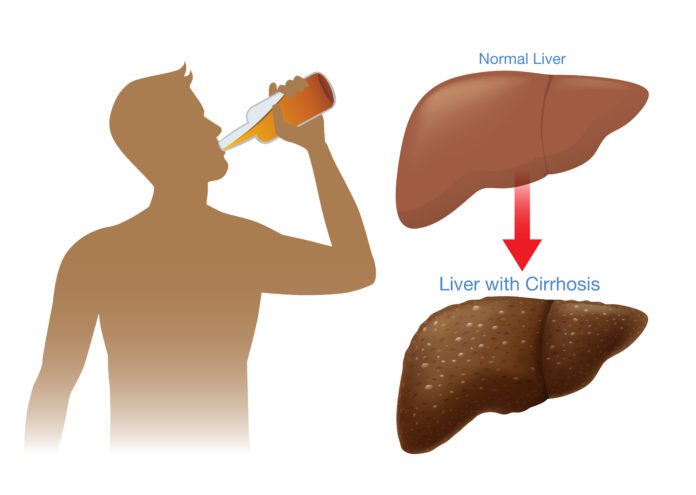 Alcohol Related Liver disease