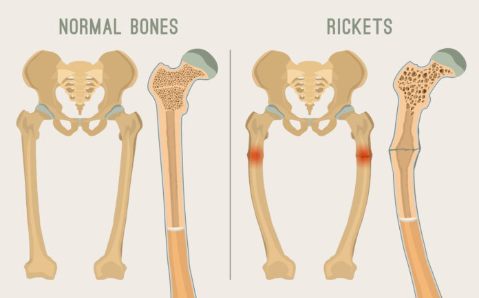 Rickets - Symptoms, Causes