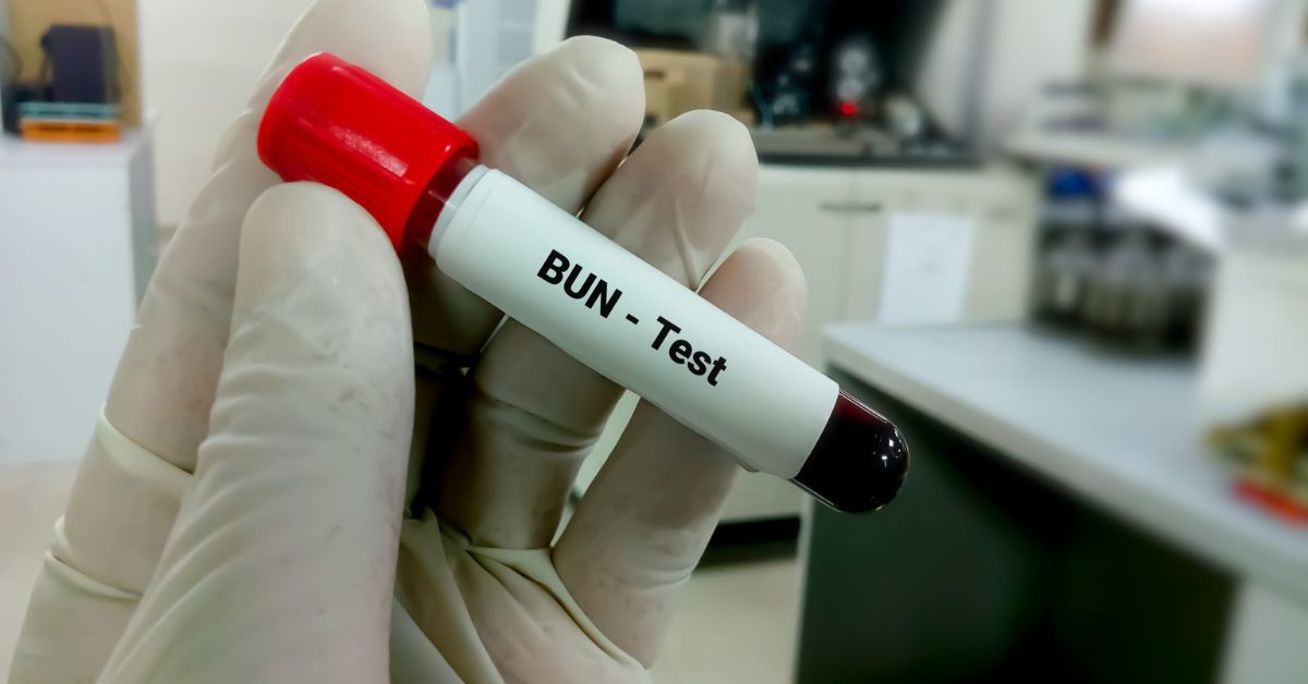 Blood Urea Nitrogen Bun Test Preparation Results And Risk Factors