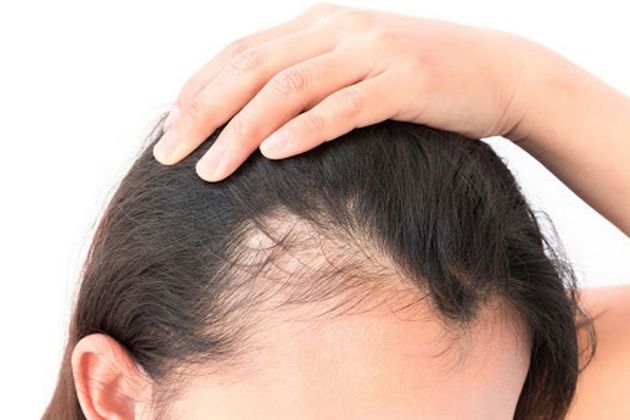 Hair Loss in Women: Causes and Treatments for Every Age - GoodRx