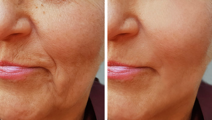 Facial Fillers for Wrinkles