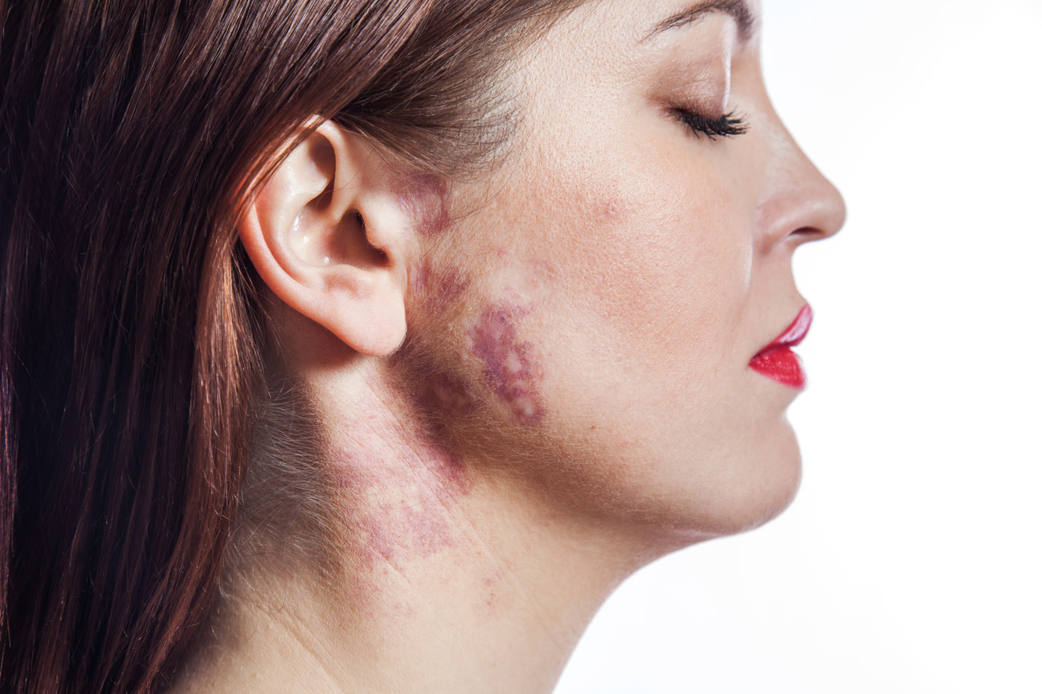 what-are-pigmented-birthmarks-apollo-hospital-blog