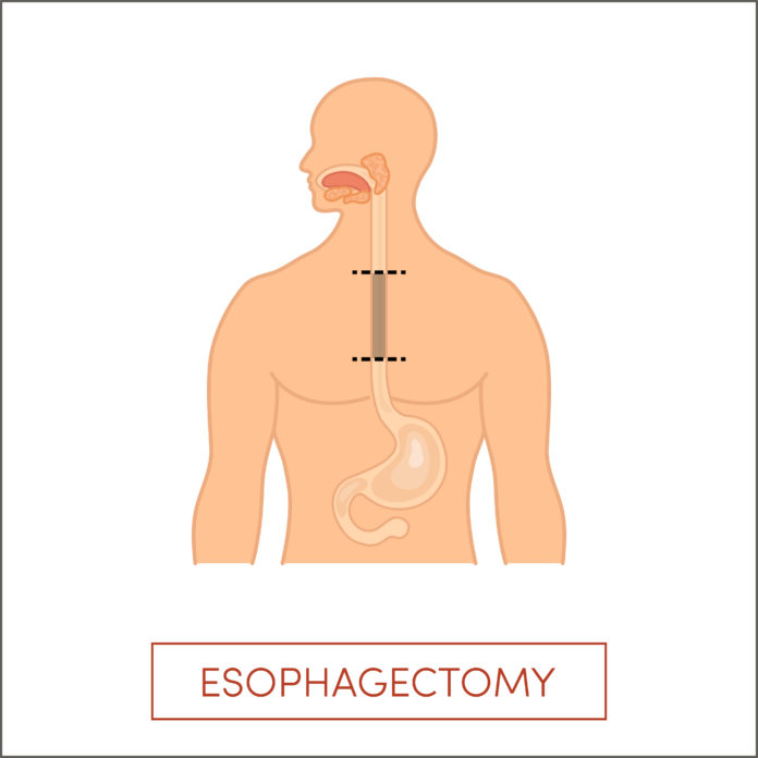Esophagectomy