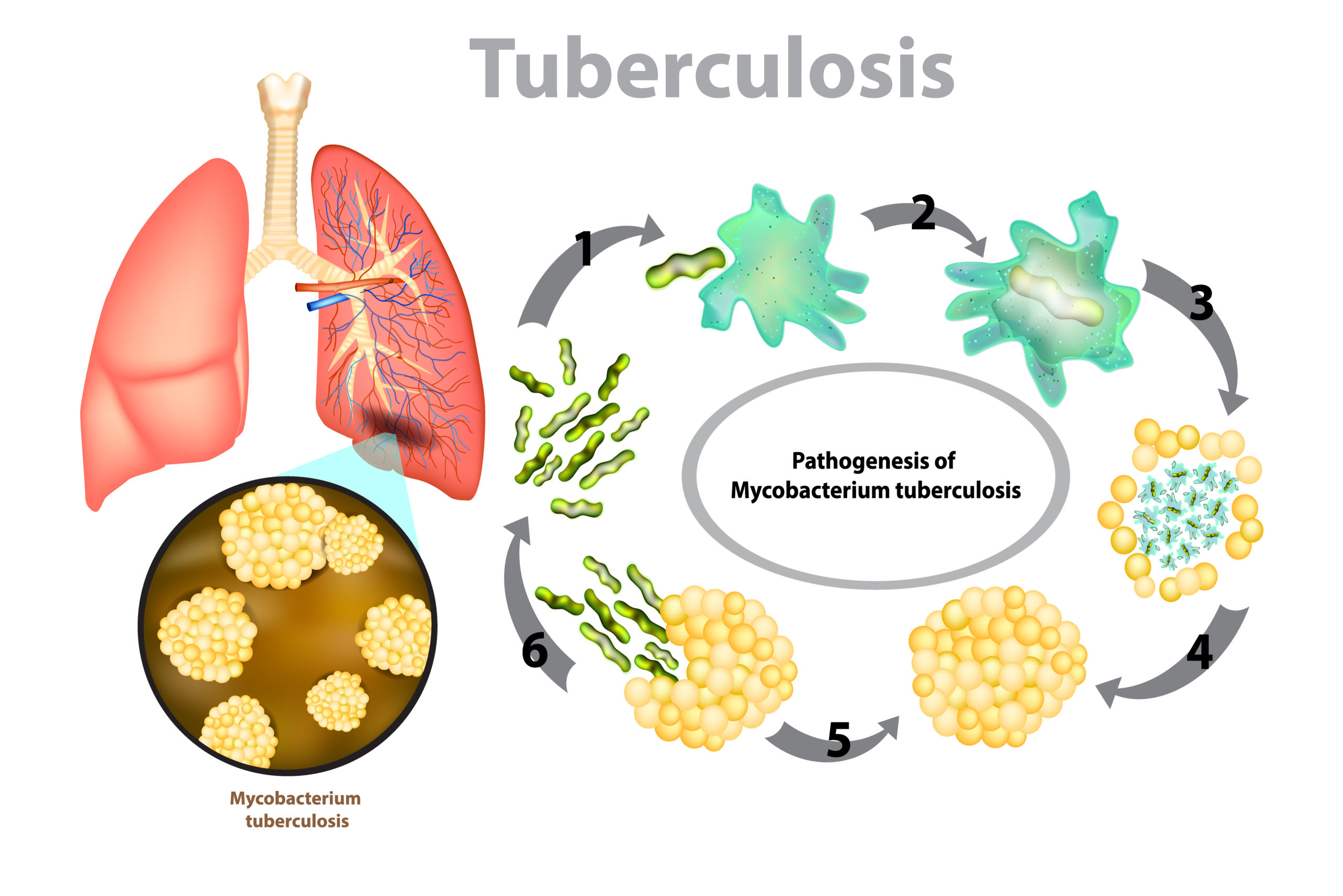 Lifestyle Changes to Treat Tuberculosis at Home - Apollo Hospitals Blog