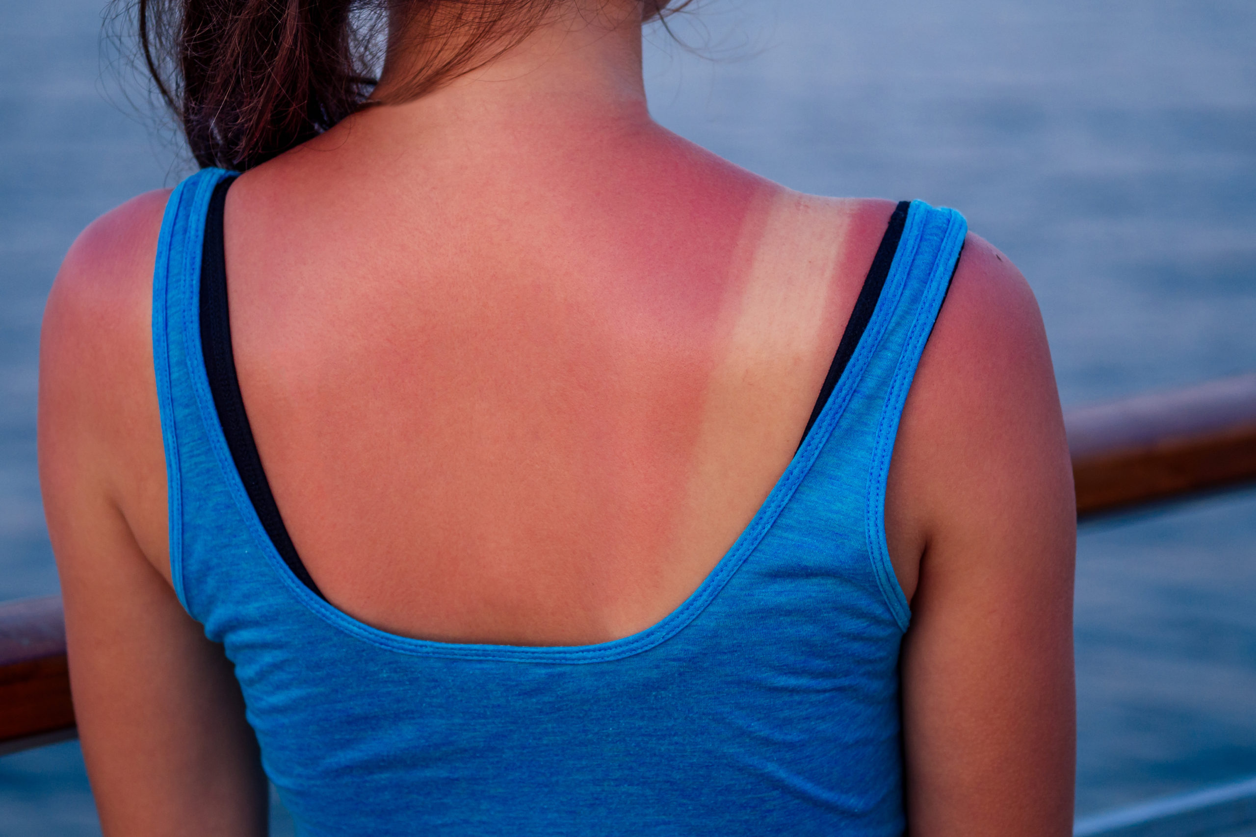 Sunburn Causes Symptoms Home Remedies And Treatment