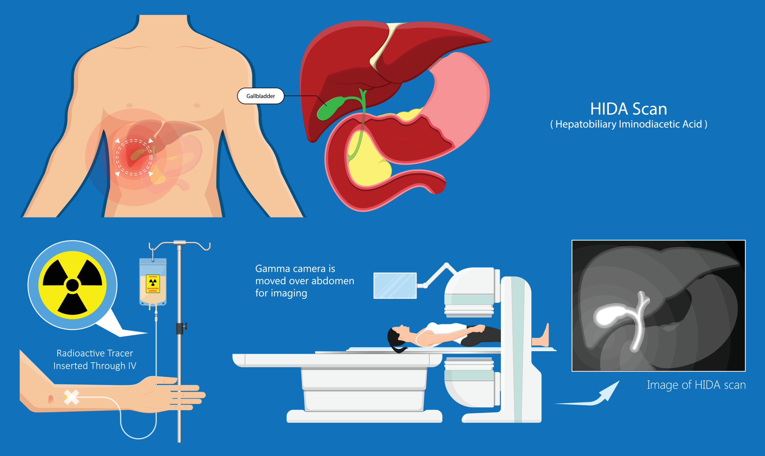HIDA Scan Procedure, Results and Cost Apollo Hospital Blog