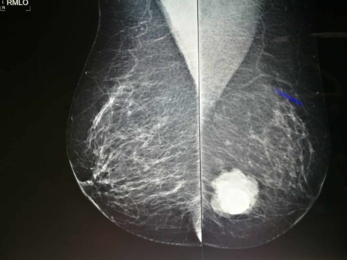 Breast Calcifications
