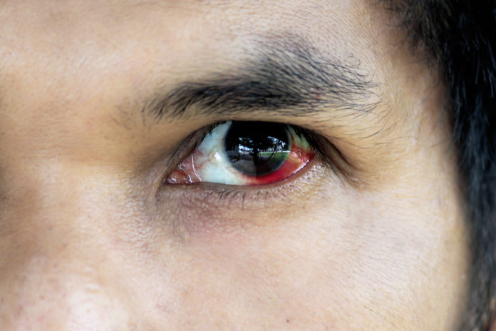 Subconjunctival Hemorrhage (Broken Blood Vessel in Eye)
