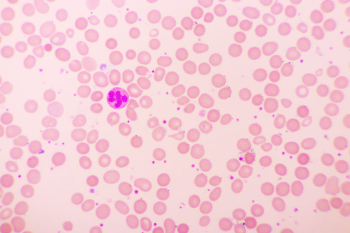 Primary & Secondary Thrombocytosis