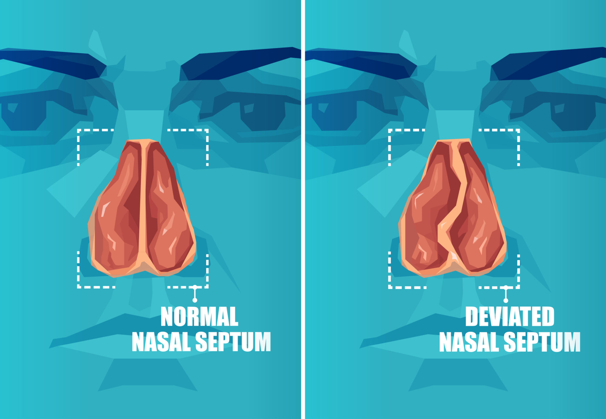 Nasal Septum Deviation Symptoms, Causes & Treatment