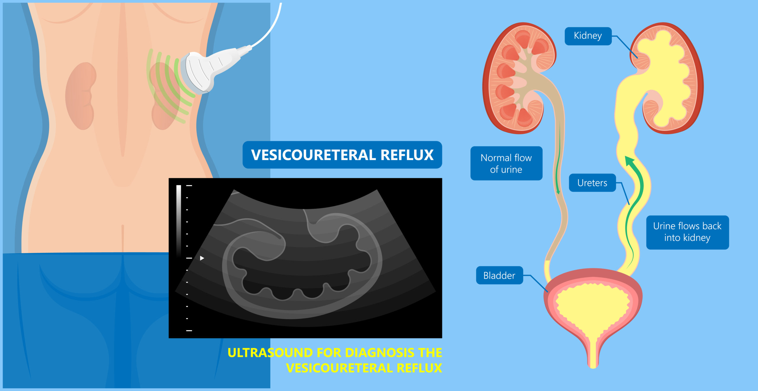 Vesicoureteral Reflux (VUR): Causes, Symptoms & Treatment