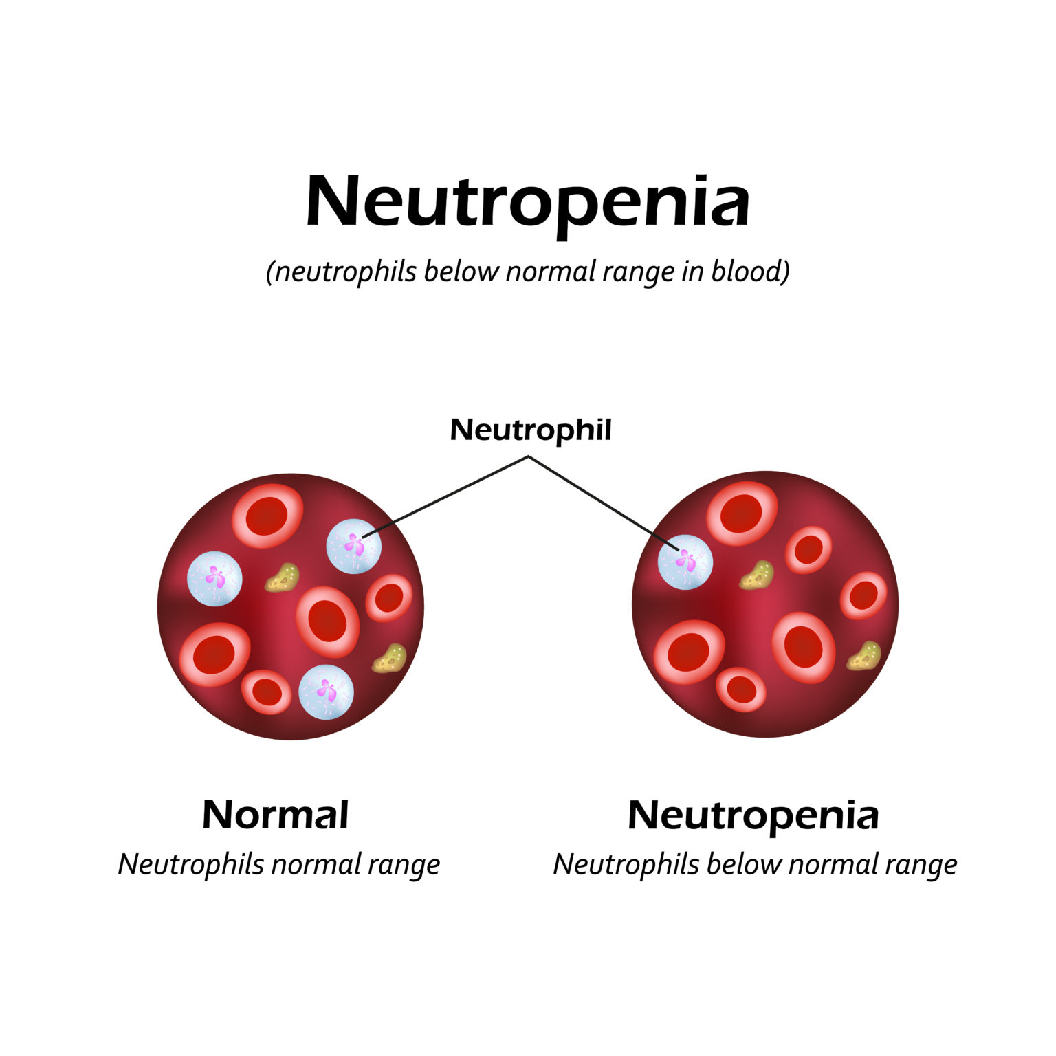 neutropenia-causes-symptoms-and-treatment-apollo-hospital-blog