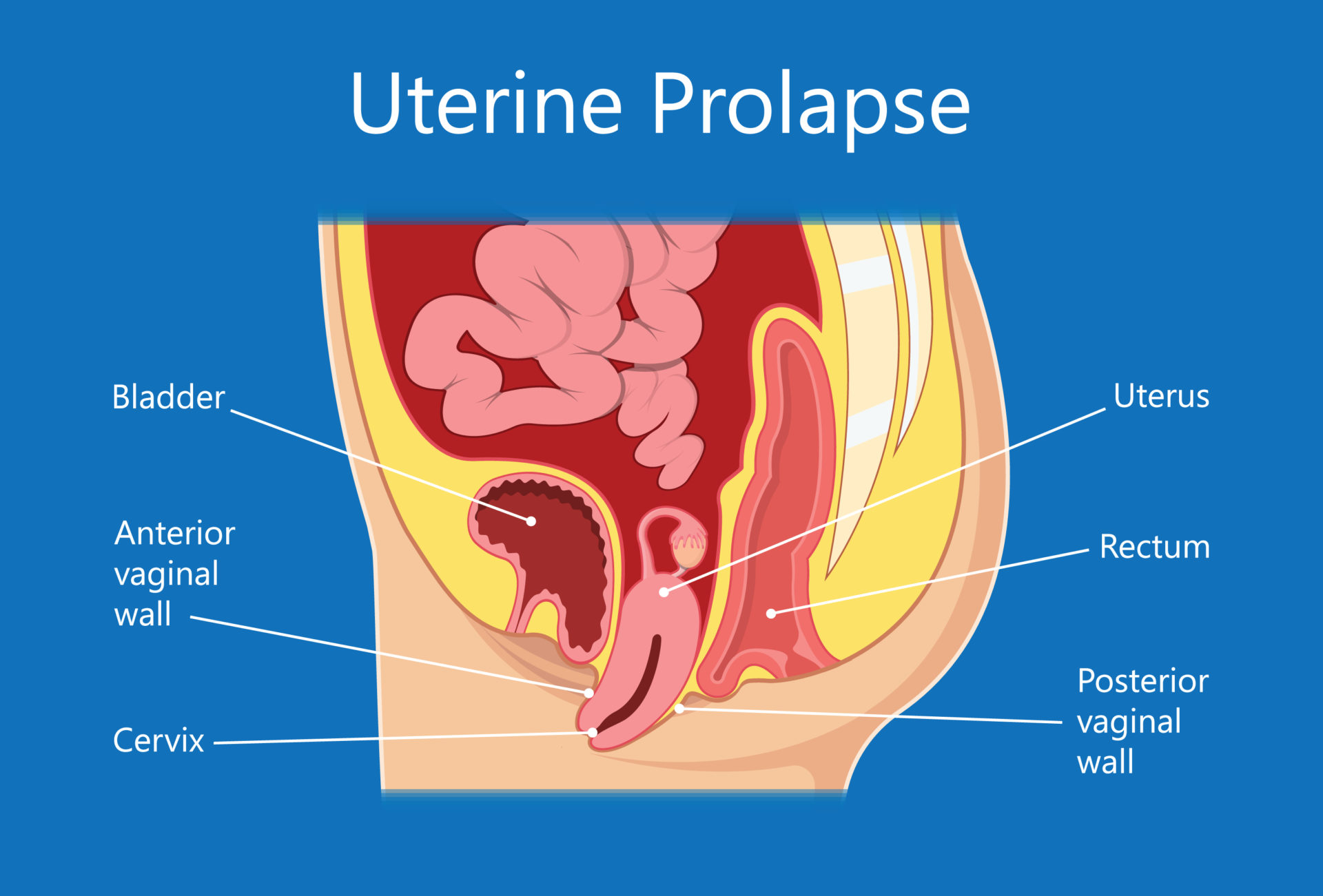 case study about uterine prolapse